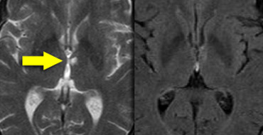 FLAIR misses thalamus infarctions